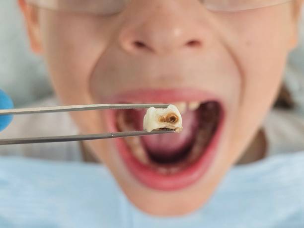 Best Emergency Dentist for Knocked-Out Tooth in Chrisman, IL
